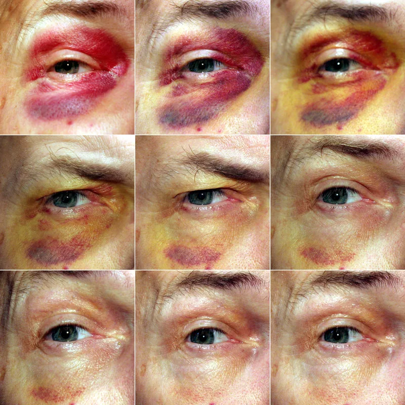 Das Blaue Auge (Albanien)